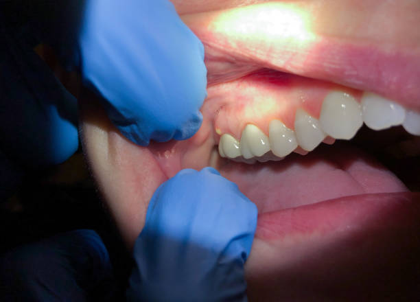 Best Emergency Denture Repair in Chackbay, LA