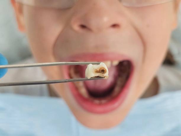 Best Broken or Chipped Tooth Repair in Chackbay, LA